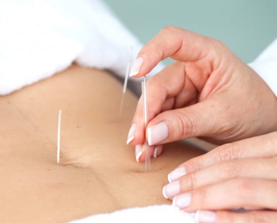 Acupunctura Tratamento Natural com Acupunctura