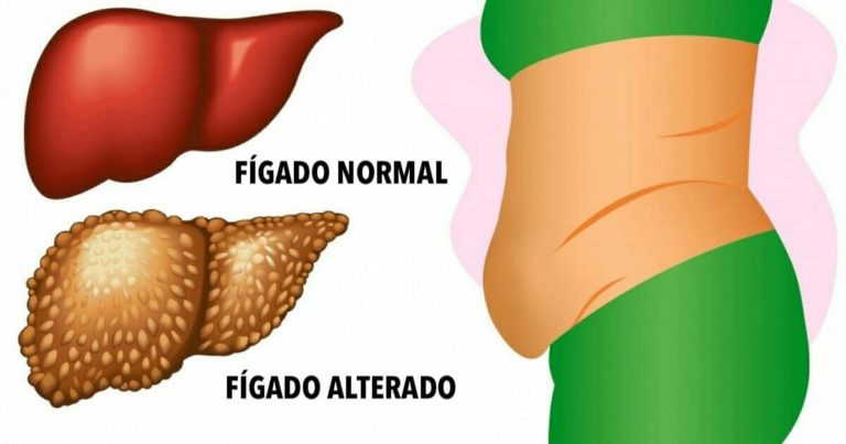 Alguns Sintomas De Problemas No Figado Alguns Sintomas De Problemas No ...