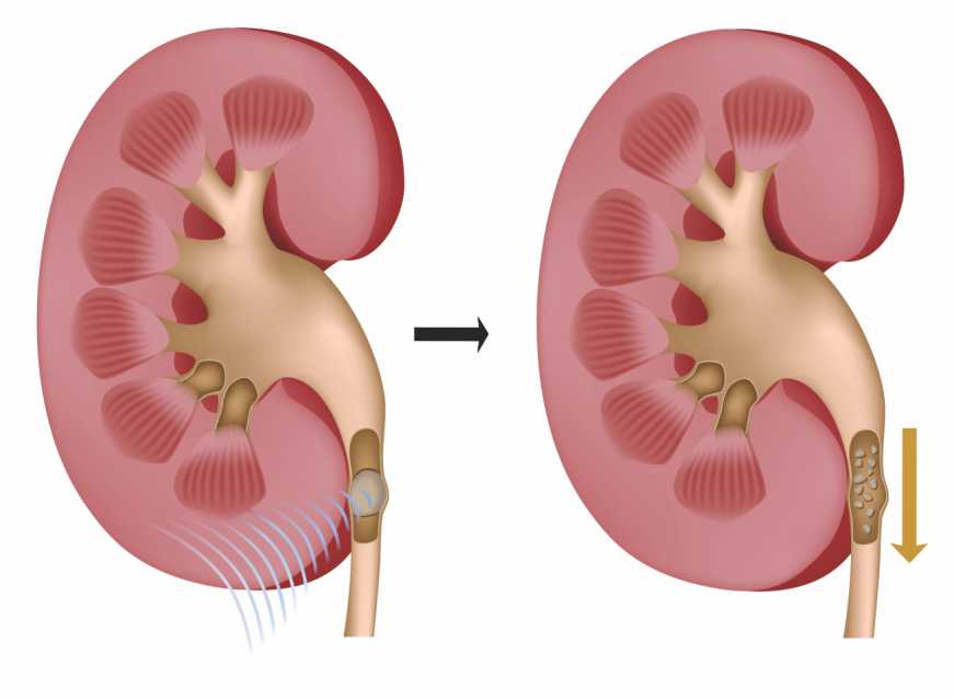 Pedra nos rins causas e sintomas Tratamento Pedra nos rins causas e sintomas Tratamento